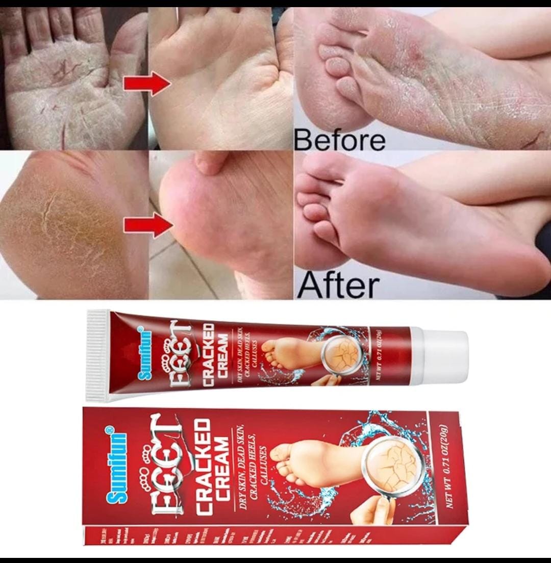 Cracked feet cream